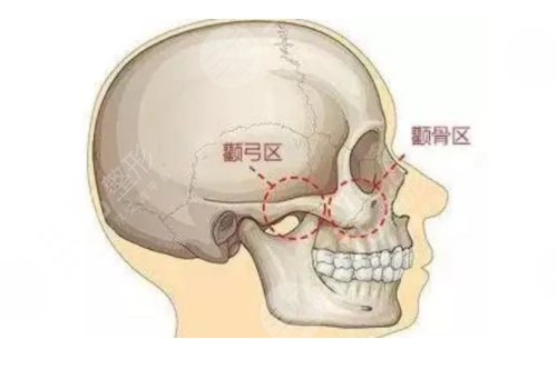 整容颧骨削骨多少钱大概？
