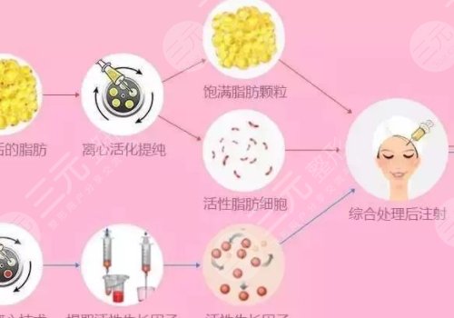 自体脂肪填充面部能保持多长时间？