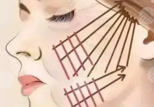 电波拉皮能维持多久？