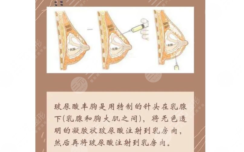 注射隆胸用的什么材料？