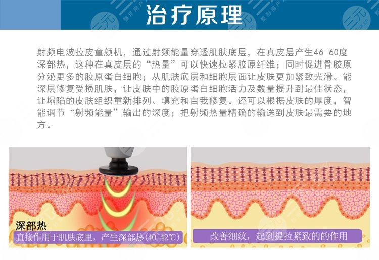 电波拉皮和热玛吉的区别在哪？