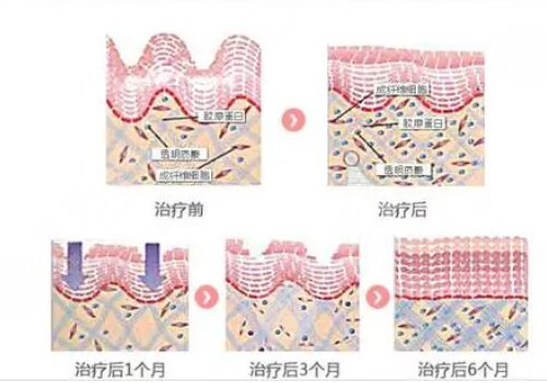 热拉提plus做一次可以维持多久