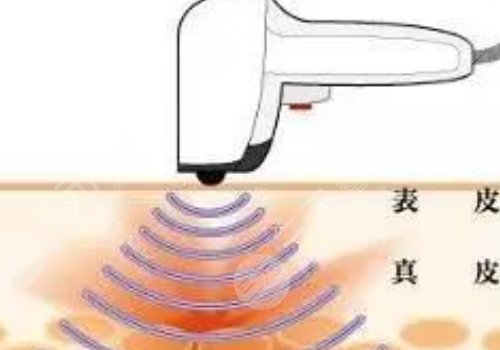 热拉提plus做一次可以维持多久