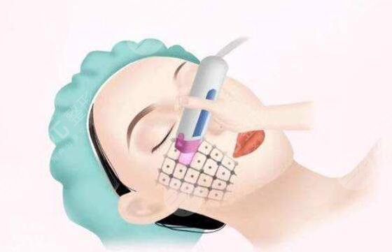 热玛吉