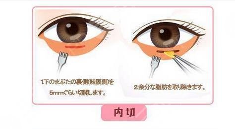内切眼袋多久可以戴隐形眼镜