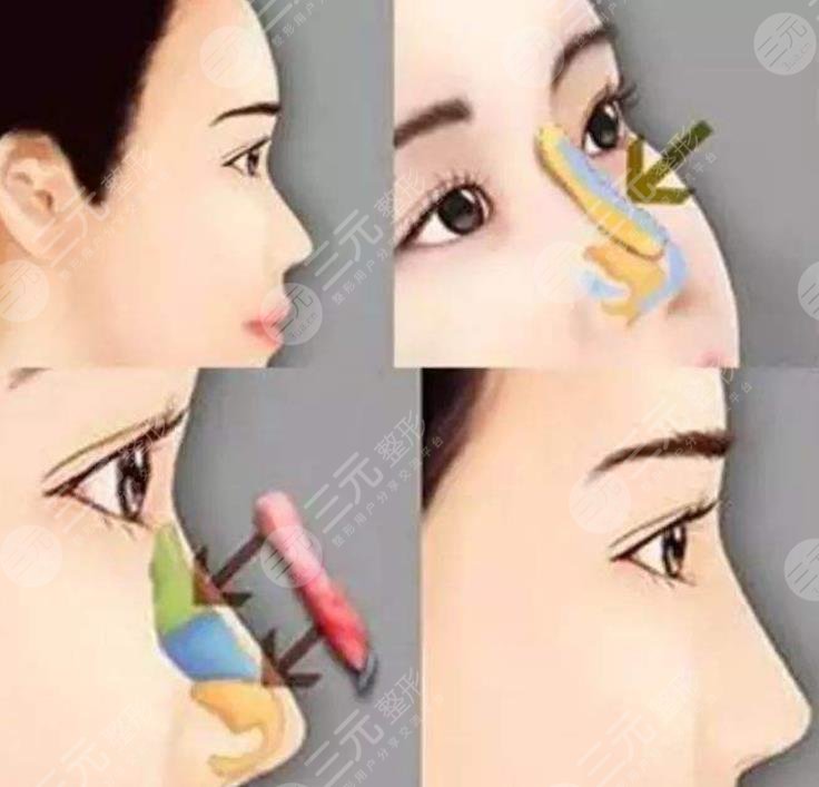 大鼻子整形一般多少钱