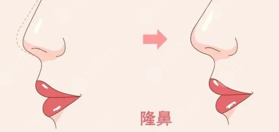 大鼻子整形一般多少钱