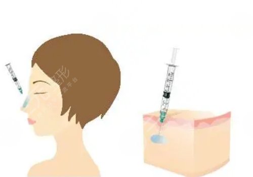 艾莉薇玻尿酸适合打哪里？