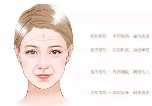 艾莉薇玻尿酸适合打哪里？