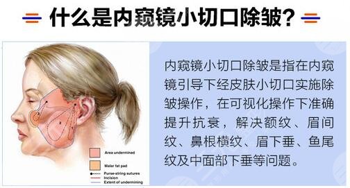 除皱