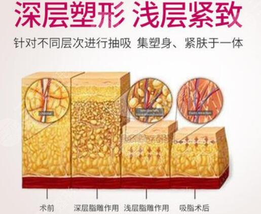 腰腹吸脂