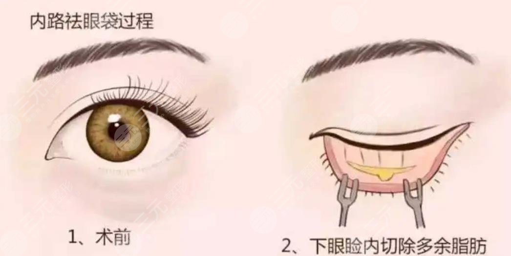 眼袋是怎么形成的