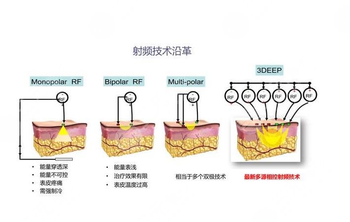 3d相控射频多久做一次？