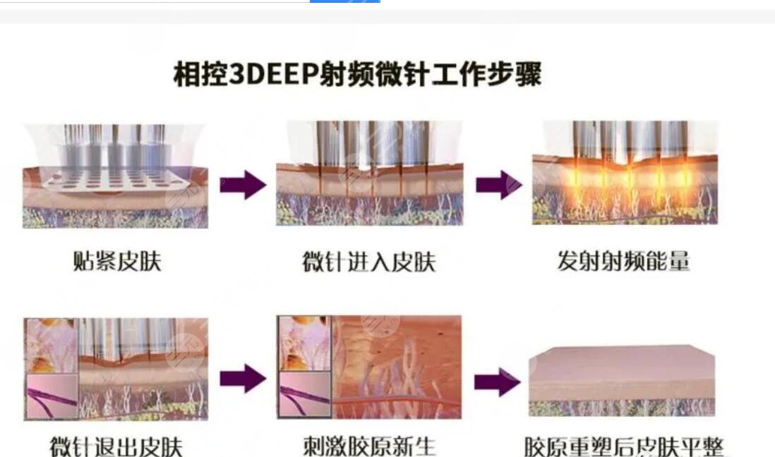 3d相控射频多久做一次？