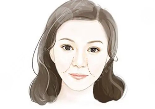 用什么填充法令纹好？