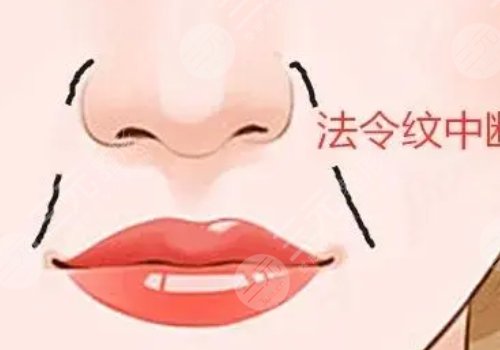 填充法令纹的具体操作方式