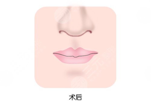 缩短人中手术会留疤吗？