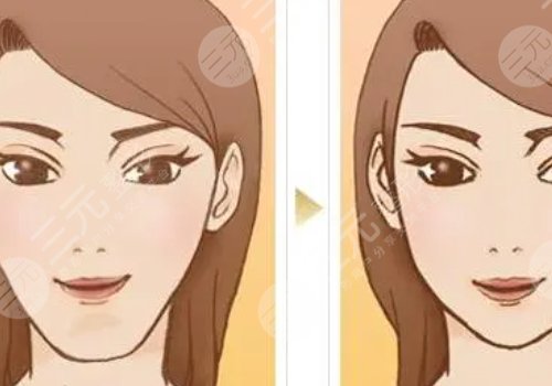 面部轮廓整形包括哪些项目？