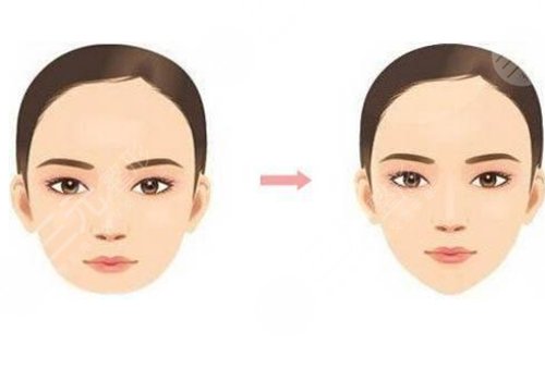 脸部轮廓整形多久能恢复？