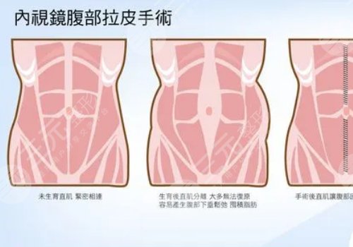 腹部拉皮和腹壁整形有哪些不一样(区别)？