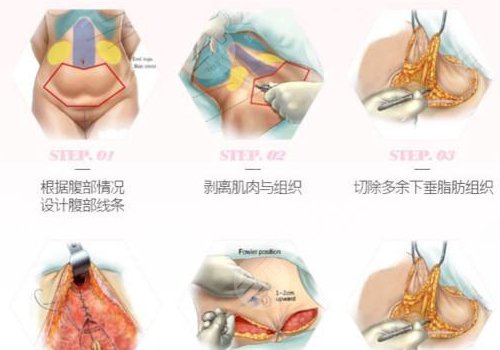 腹部拉皮和腹壁整形有哪些不一样(区别)？