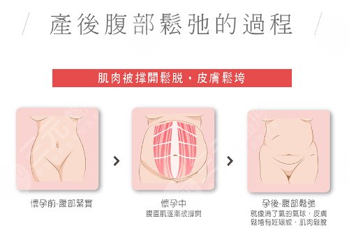 腹部拉皮和腹壁整形有哪些不一样(区别)？