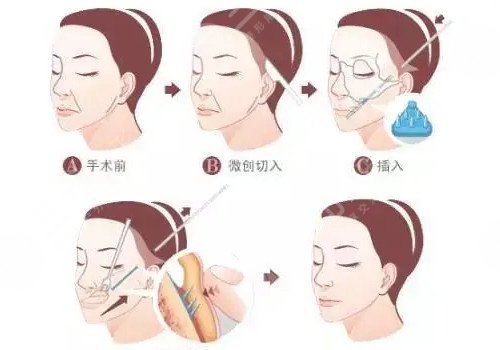 筋膜悬吊面部提升术价格是多少？