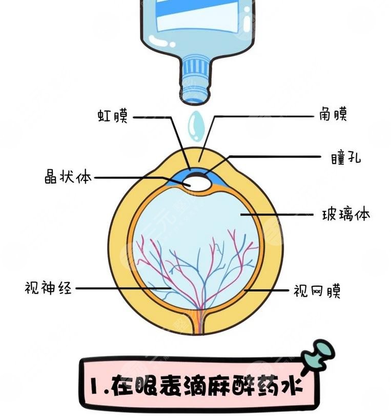 晶体植入近视眼手术要恢复多久