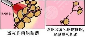 光纤溶脂