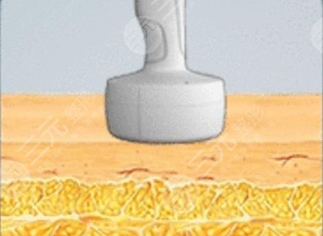 光纤溶脂