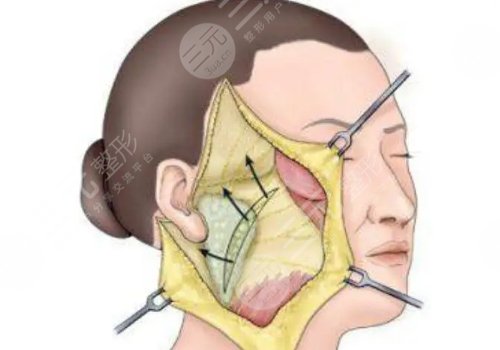医美提拉紧致多少钱?