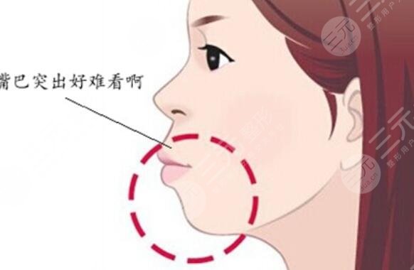 骨性凸嘴