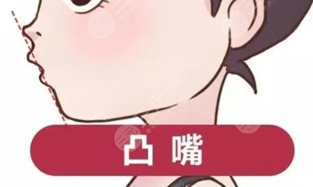 骨性凸嘴