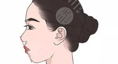 骨性凸嘴