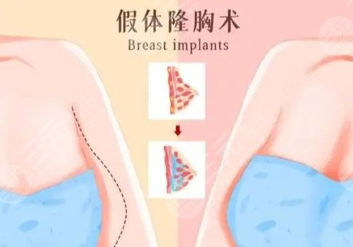 隆胸腋下切口多久可以抬手？
