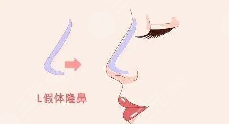 膨体和硅胶的区别是什么?