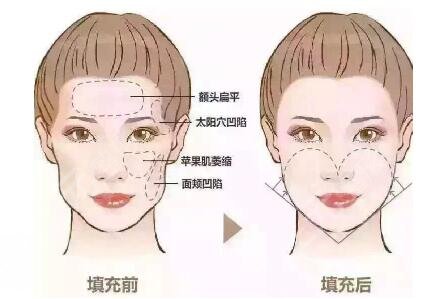 脂肪填充脸部的注意事项