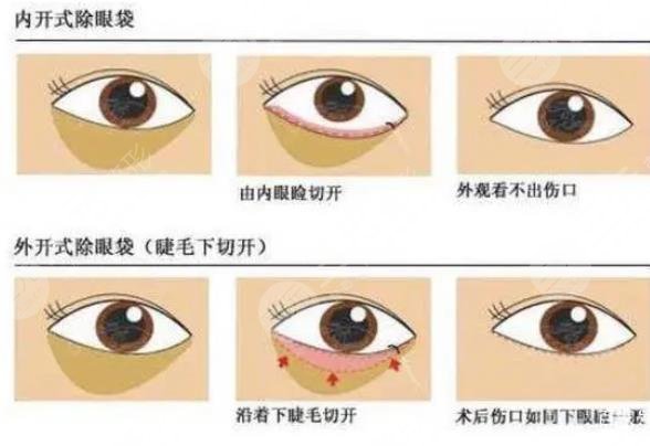 水剥离祛眼袋是什么