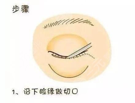 水剥离祛眼袋是什么