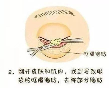 水剥离祛眼袋是什么