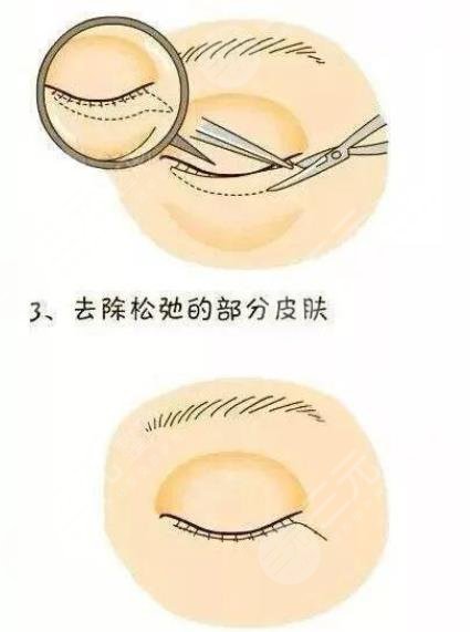 水剥离祛眼袋是什么
