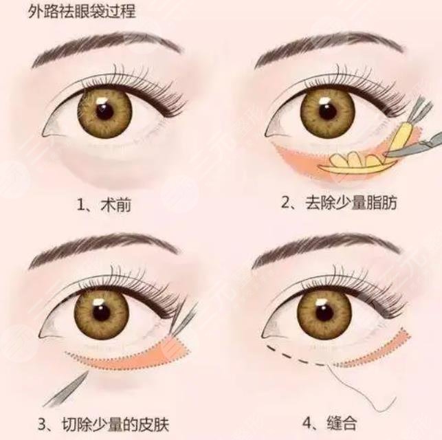 外切眼袋手术恢复期要多久