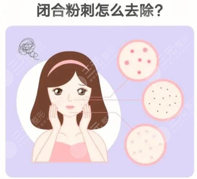 闭合性粉刺怎么清理