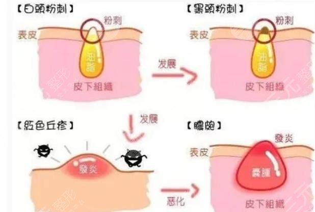闭合性粉刺怎么清理