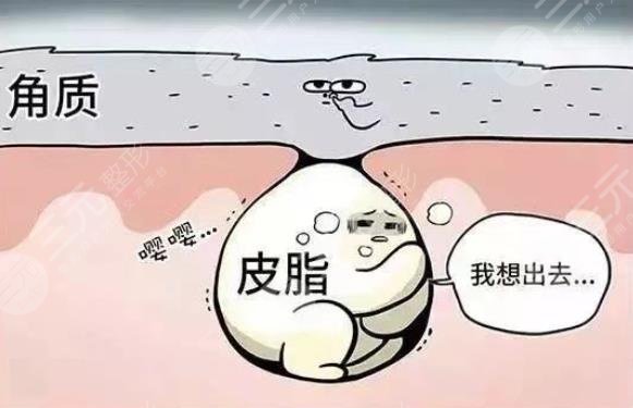 闭合性粉刺是怎么引起的