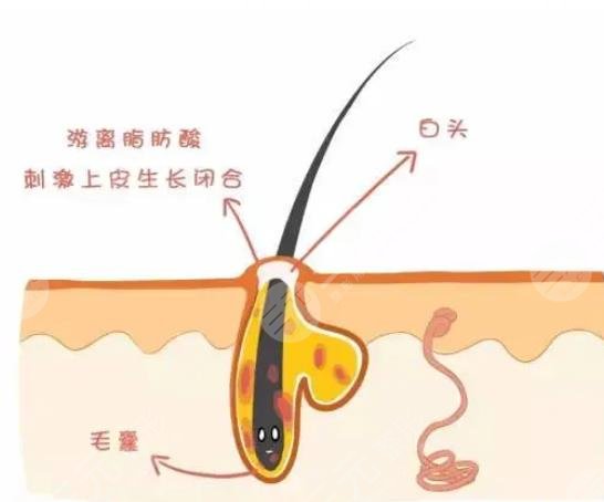 闭合性粉刺是怎么引起的