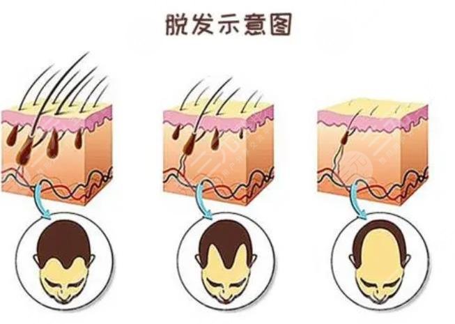 种一根头发需要多少钱