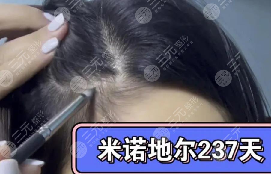 涂抹米诺地尔