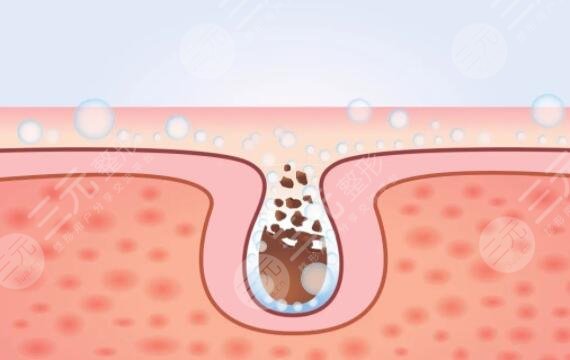 光动力治疗