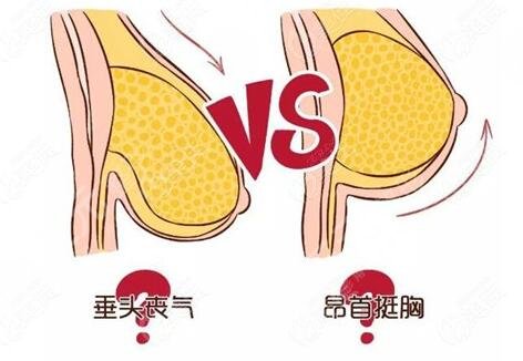 下垂胸怎么矫正有效果？手术与非手术方法都可选！产后妈妈的救星！
